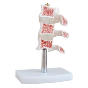 Osteoporosis Model