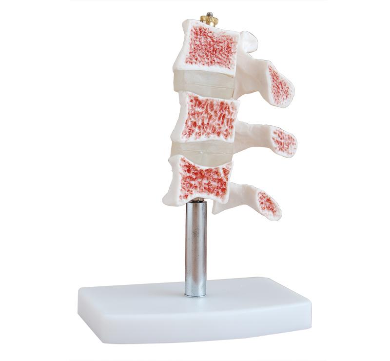 Osteoporosis Model