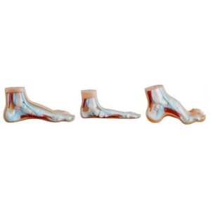 Flat Foot